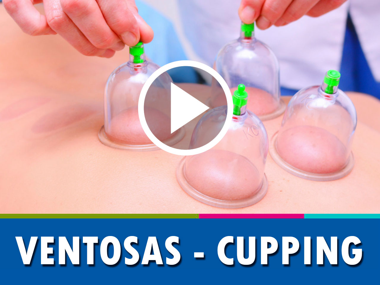 Cupping